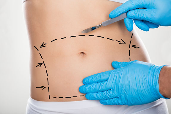 Abdominoplastik Hildesheim