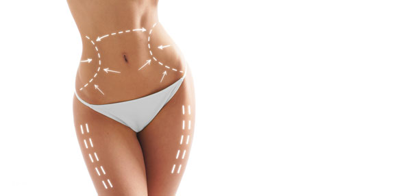 Liposuktion Hildesheim